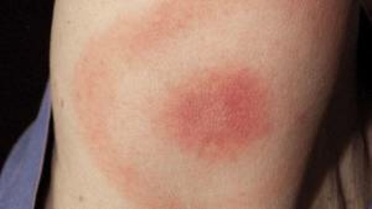 Lyme Borreliose Symptome Diagnose Therapie Behandlung Erreger Was