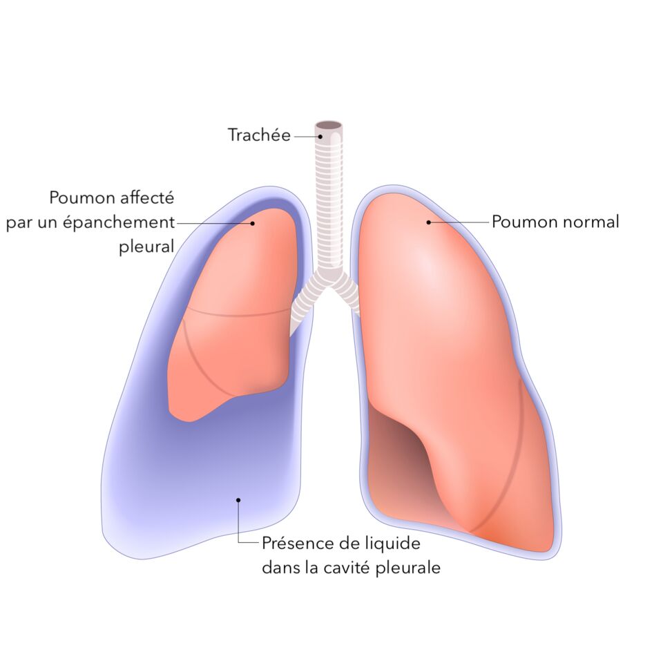 Épanchement pleural symptômes causes diagnostic traitement de