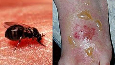 NHS On High Alert As They Warn Of Blandford Fly Epidemic This Summer