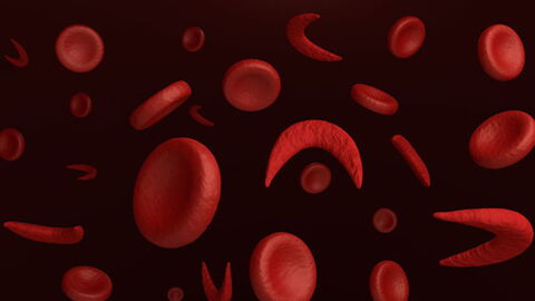 Sickle-Cell Anaemia: Definition, Symptoms, Cause, Treatment, Cure