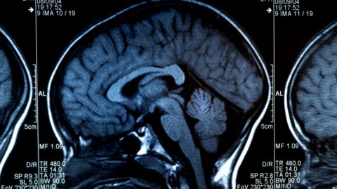 Alzheimer's Disease: Early Signs, Symptoms, Stages, Causes, And Treatment