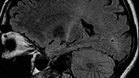 ALS (Lou Gehrig's Disease): Symptoms, Signs, Causes, Treatments