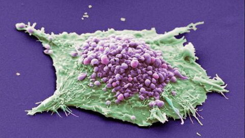 Cancer: Signs, Symptoms, Types, Stages, Detection