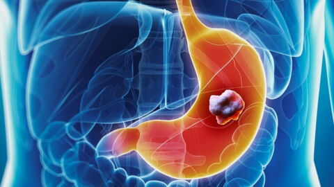 Stomach Cancer: Symptoms, Life Expectancy, Treatment
