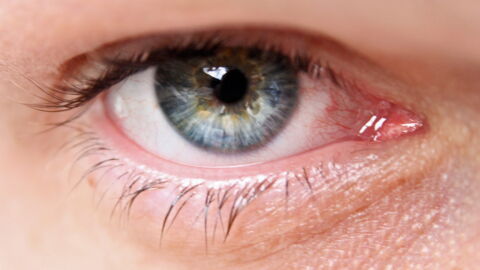 Glaucoma: Definition, Symptoms, Test, Causes, Treatment