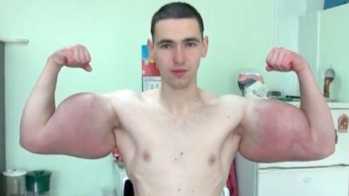 synthol side effects