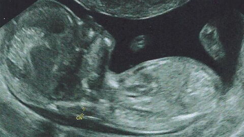 What Is Down Syndrome? Definition, Causes, Symptoms, Detection, Screening, Life Expectancy