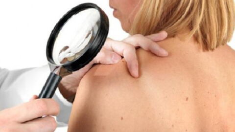 Lupus: What Is It, Signs, Symptoms, Cause, Test, Treatment, Cure