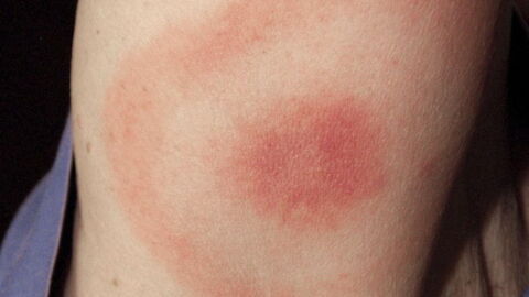 Lyme Disease: Symptoms, Diagnosis, How To Treat, Tests, Prevention, And Pictures