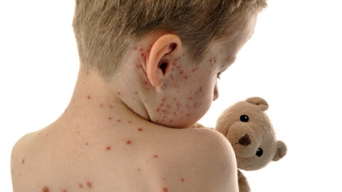 Measles (Rash): Symptoms, Treatment, Vaccine, What Is It?