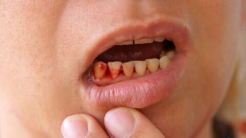 This Deadly 18th Century Disease Is Making A Frightening Comeback To Developed Countries