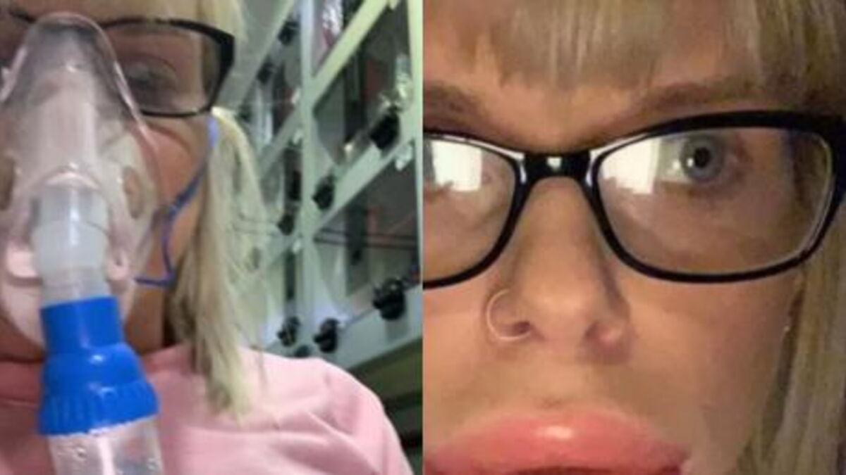 Woman Took Allergic Reaction To Lip Augmentation And Here Is The Result