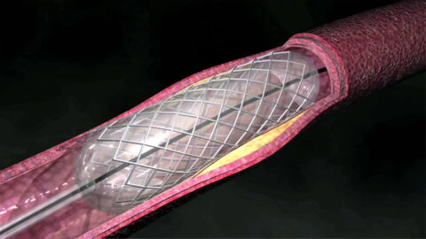 What Is An Angioplasty? Definition, Stent, Meaning, Risks, Recovery Time