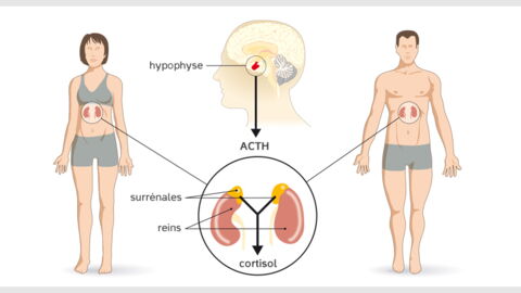 Cushing's Syndrome: Symptoms, Treatment And Diagnosis