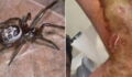 Spider Bite Turned Into A Life Threatening Situation For This Brit