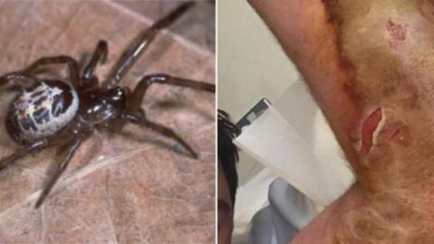 Spider Bite Turned Into A Life Threatening Situation For This Brit