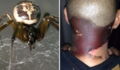 This Londoner's Skin Turned Black After He Was Bitten By A Spider In His Garden
