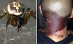 This Londoner's Skin Turned Black After He Was Bitten By A Spider In His Garden