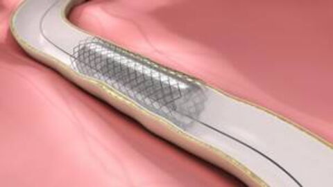 Stent: In Heart Or Kidney, Procedure, Recovery Time