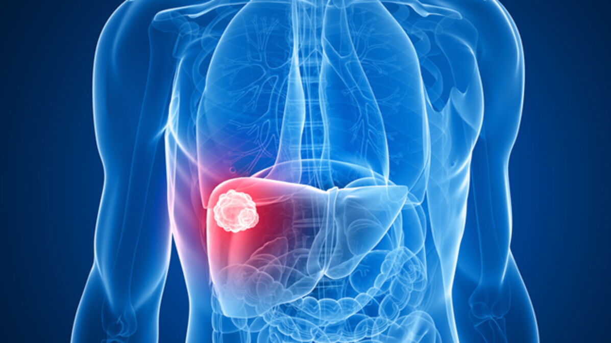 Liver Cancer Symptoms, Prognosis, Stages, Treatments, Survival Rate