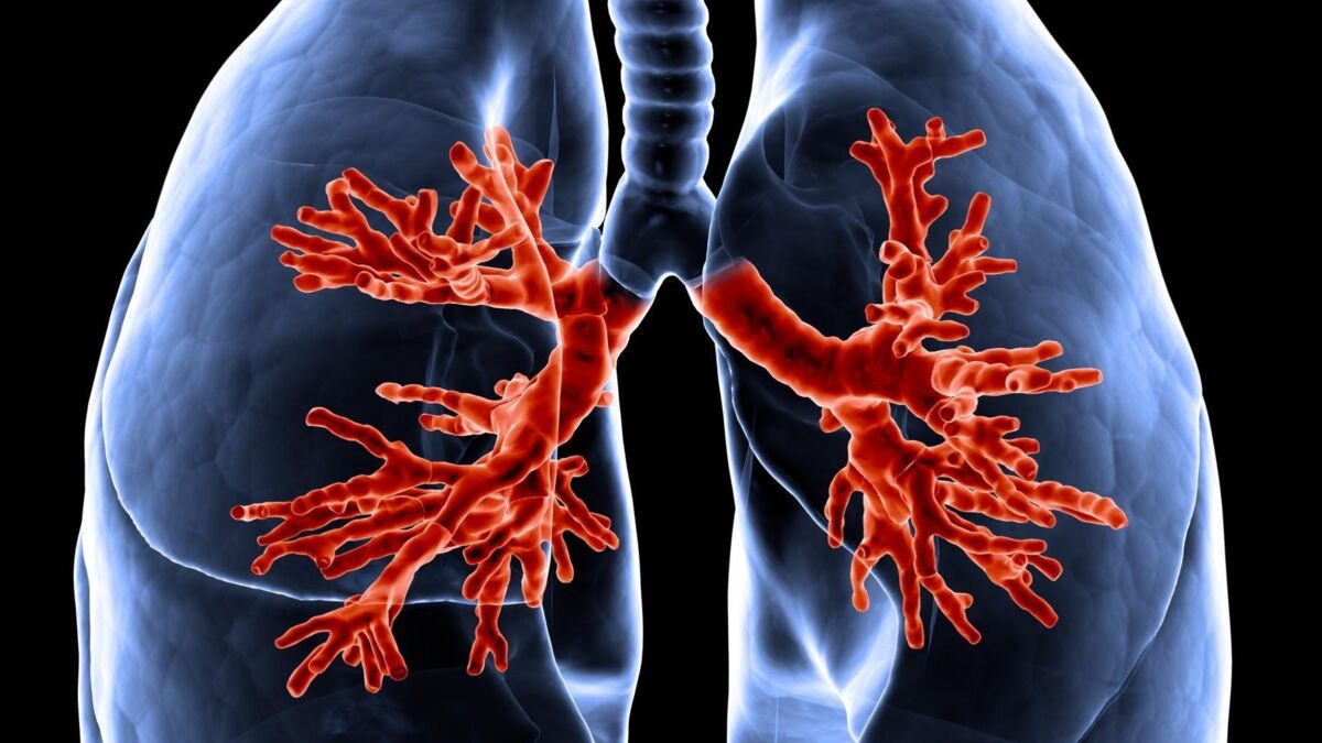 Cystic Fibrosis Definition Sympmtoms Causes Treatment Life Expectancy 1037