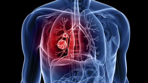 Lung Cancer: Symptoms, Stages, Signs, Diagnosis, Causes, Treatment, Survival Rates