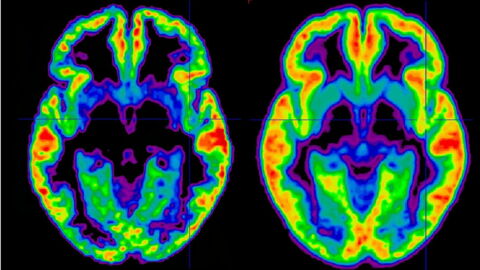 Schizophrenia: What Is It, Symptoms, Signs, Causes, Test, Treatment, Cure, Paranoia?