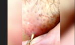 He Tried To Squeeze A Spot On His Neck And Something Horrific Came Out