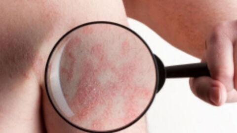 Psoriasis: Symptoms, Causes, Treatments, And Cures