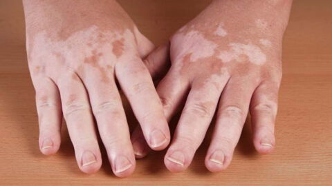 Vitiligo: Symptoms, Causes, and Treatments