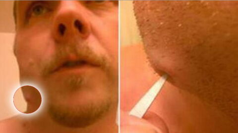 This Man Had A Dental Abscess And Had The Brilliant Idea To Burst It Himself
