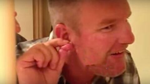 After Popping A Giant Pimple On His Face, This Man Got A Huge Shock