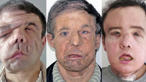 This Man's Life Changed Forever After Undergoing The World's First Face Transplant
