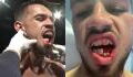 Boxer breaks jaw in half and shares injury on video