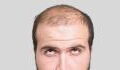 Hair Loss: Can You Fight Against It And Really Eradicate It?