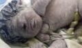 Egyptian woman gives birth to rare 'cyclops' baby