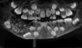 A young boy has 526 teeth removed from his mouth