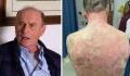 74-year-old patient sees skin 'peeling off' after being vaccinated