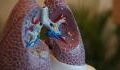 CAT scans reveal COVID damage on people lungs