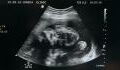 This woman's foetus was pregnant with her own twin brother