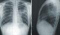 Pneumonia: These symptoms may be a sign of this COVID complication
