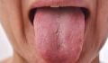 COVID tongue: The nasty new coronavirus symptom