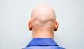 Study shows bald men are at higher risk of contracting severe COVID