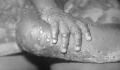 Monkeypox: Outbreak of rare viral disease has been confirmed in the UK