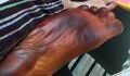 His foot turned black overnight and his wife was to blame!