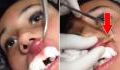 Doctor removes a horrifying parasite hiding inside a woman's lip