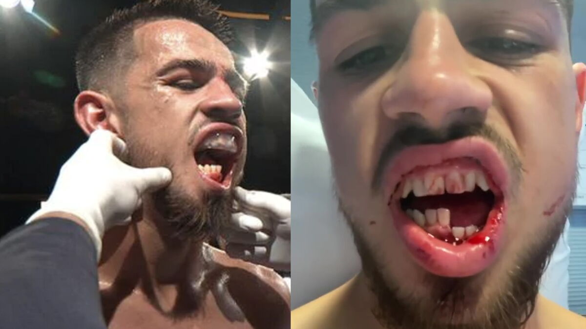 Boxer breaks jaw in half and shares injury on video