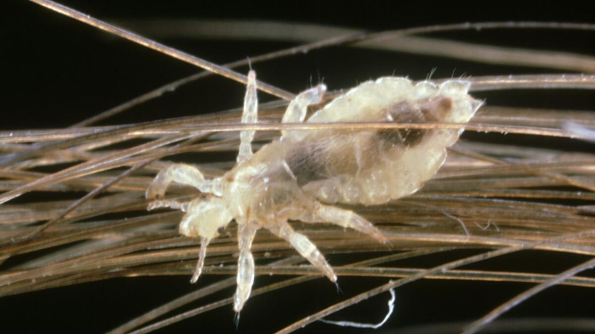 WATCH Hairdresser films the worst lice infestation of her career