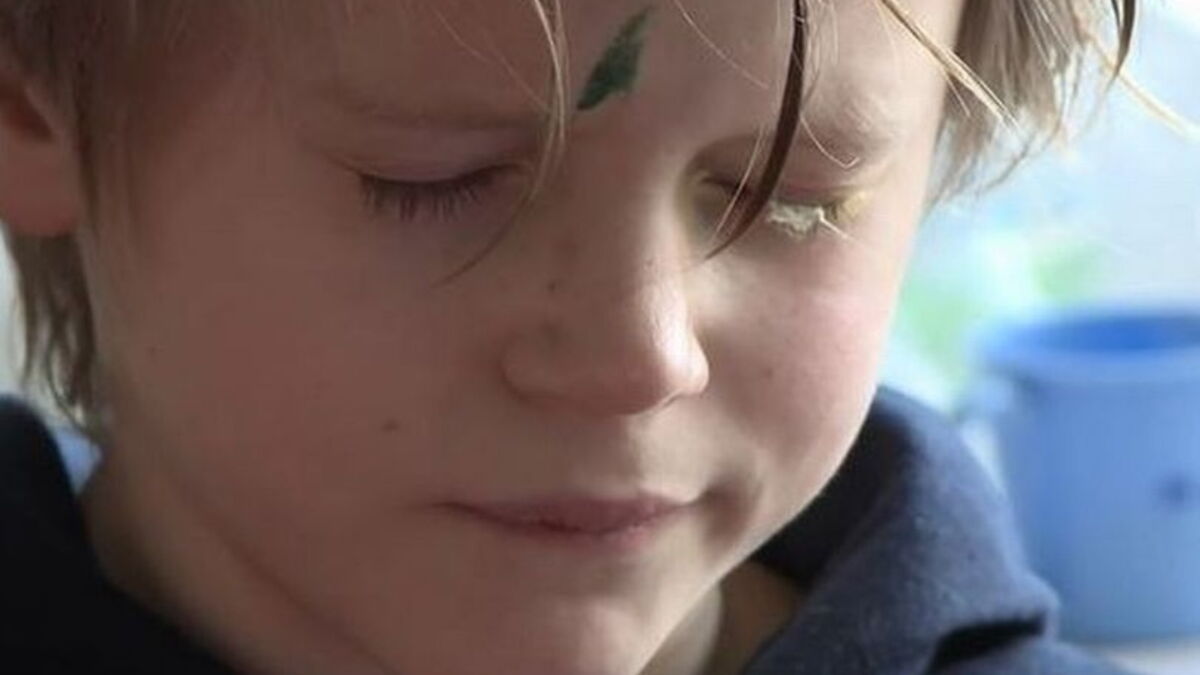 Boy’s eye glued shut for four days after dad mistook superglue for eye