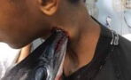 A needlefish attacked and pierced this teenager's neck